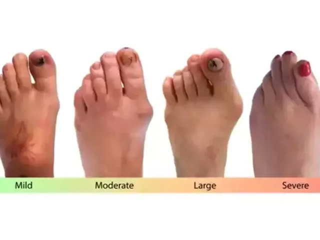 هالوکس والگوس چیست؟